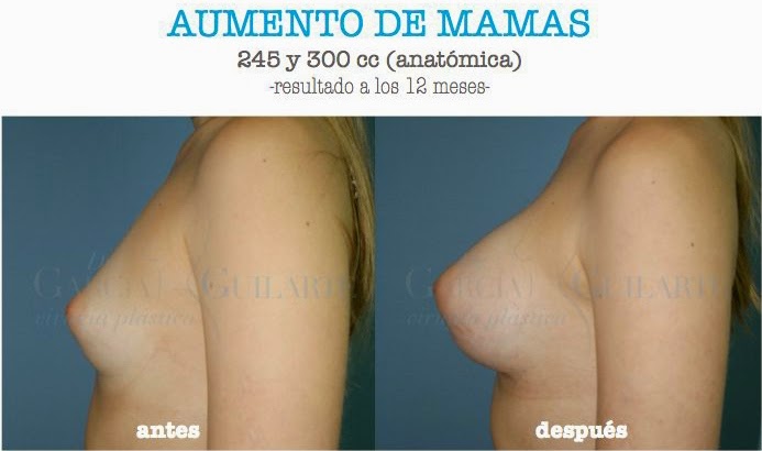 Tolyatti aumentar los pechos el precio
